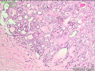 甲状腺肿物，腺瘤？腺癌？图4