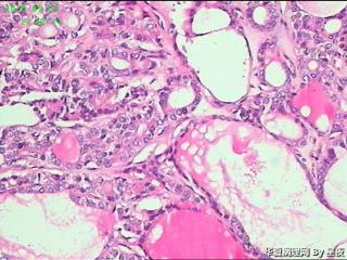 甲状腺肿物，腺瘤？腺癌？图7