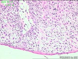 梨状窝肿物活检组织，请教？图6