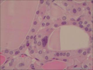 甲状腺肿物图13
