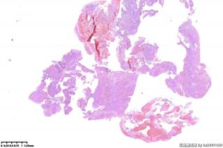 宫颈，乳头状鳞状细胞癌？图2