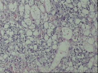 卵黄囊瘤图1