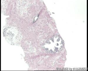 请教前列腺穿刺，前列腺癌吗？图17