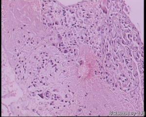 宫颈液基+内膜诊刮（大片凝血，仅见小灶组织，腺细胞？印戒？））图8