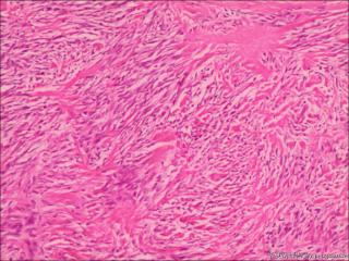 卵巢纤维瘤？图2