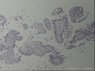 微乳头状尿路上皮癌图1