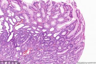 胃窦粘膜，炎症？图7