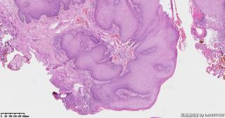 外阴及肛周组织，尖锐湿疣？图2