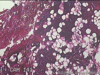 右侧腮腺肿物图19