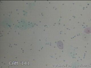 HPV12阳性图21