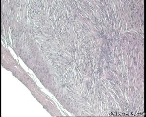 请教！左小腿肿物，神经鞘瘤细胞生长活跃吗？还是细胞退变？图3