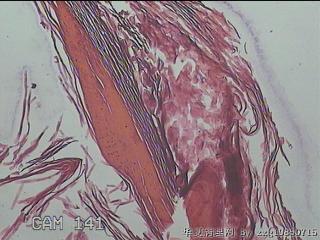 右侧腹股沟处息肉状物图15