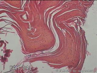 右侧腹股沟处息肉状物图17