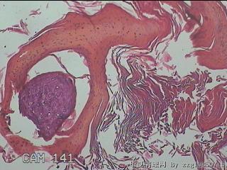右侧腹股沟处息肉状物图14