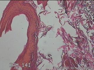 右侧腹股沟处息肉状物图28