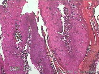 右侧腹股沟处息肉状物图26
