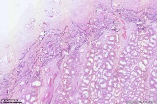 请老师们帮看看这个睾丸的区域，腺瘤样瘤？图7
