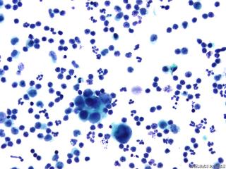 肝癌晚期腹水找瘤细胞图18