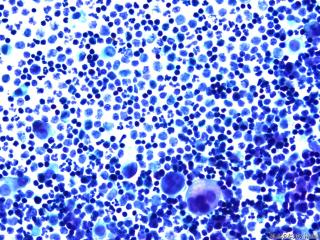 肝癌晚期腹水找瘤细胞图9