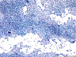 肝癌晚期腹水找瘤细胞图1