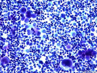 肝癌晚期腹水找瘤细胞图8