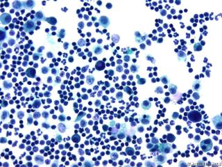 肝癌晚期腹水找瘤细胞图5