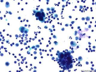 肝癌晚期腹水找瘤细胞图17