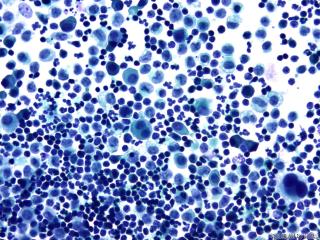 肝癌晚期腹水找瘤细胞图7