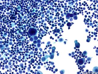 肝癌晚期腹水找瘤细胞图3