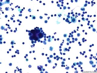 肝癌晚期腹水找瘤细胞图16