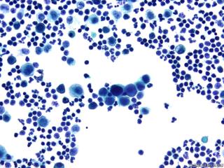 肝癌晚期腹水找瘤细胞图4