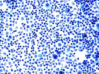 肝癌晚期腹水找瘤细胞图10