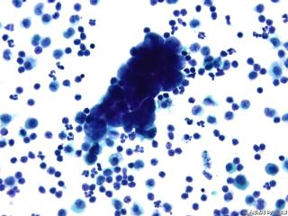 肝癌晚期腹水找瘤细胞图19