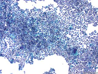 肝癌晚期腹水找瘤细胞图12