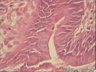 十二指肠降段，腺体轻度不典型增生     胃镜怀疑癌变。图4