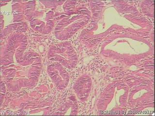 十二指肠降段，腺体轻度不典型增生     胃镜怀疑癌变。图2