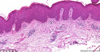 请皮肤病理的老师指导！湿疹？图3