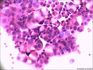 腹水细胞涂片及细胞蜡块图8