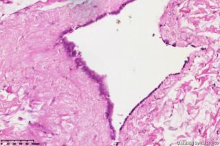 睾丸鞘膜积液组织，请教图片中是否是间皮细胞？有临床意义吗？图10