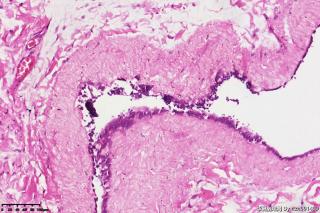 睾丸鞘膜积液组织，请教图片中是否是间皮细胞？有临床意义吗？图8