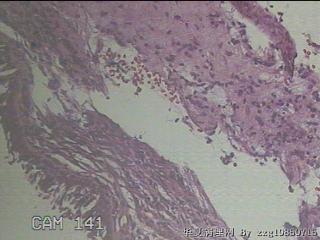 双侧鼻腔新生物图28