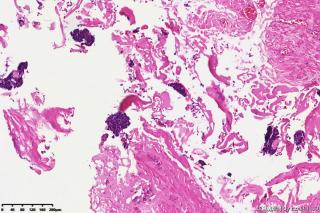 睾丸鞘膜积液组织，请教图片中是否是间皮细胞？有临床意义吗？图6