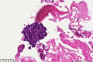 睾丸鞘膜积液组织，请教图片中是否是间皮细胞？有临床意义吗？图7