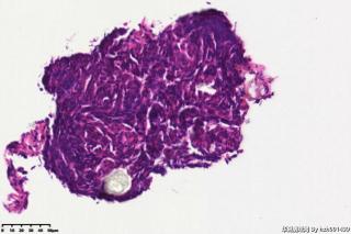 睾丸鞘膜积液组织，请教图片中是否是间皮细胞？有临床意义吗？图3