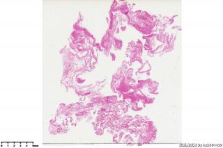 睾丸鞘膜积液组织，请教图片中是否是间皮细胞？有临床意义吗？图1