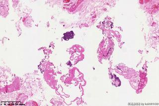 睾丸鞘膜积液组织，请教图片中是否是间皮细胞？有临床意义吗？图2