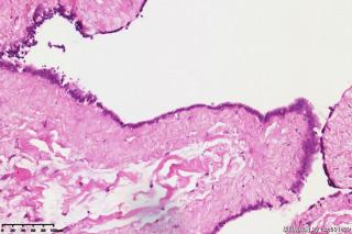 睾丸鞘膜积液组织，请教图片中是否是间皮细胞？有临床意义吗？图9