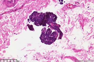 睾丸鞘膜积液组织，请教图片中是否是间皮细胞？有临床意义吗？图5