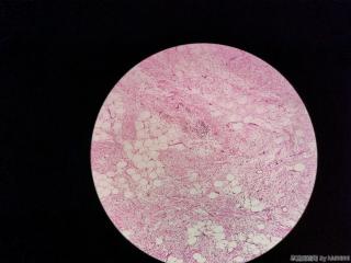 腹股沟肿物（纤维脂肪瘤？）图5