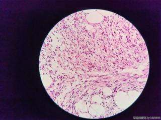 腹股沟肿物（纤维脂肪瘤？）图10